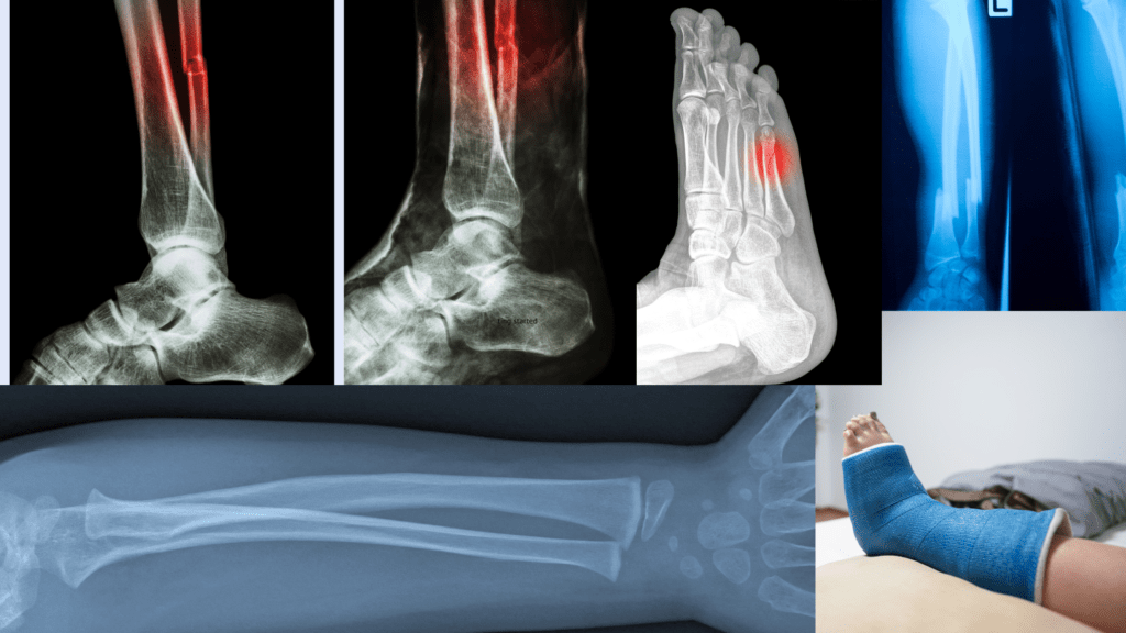 Triathletes And Stress Fractures Puretriathlon.co.uk